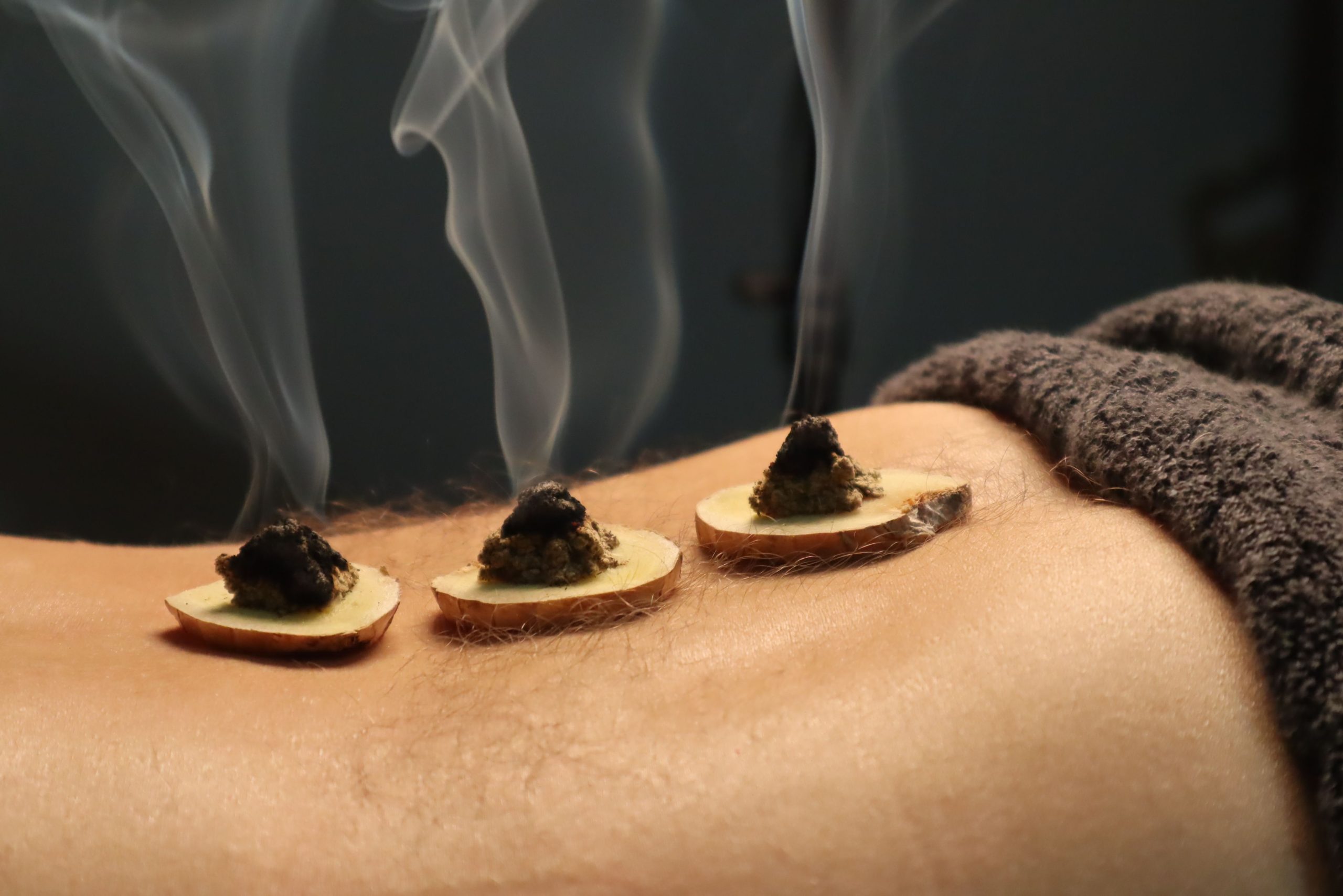 La moxibustion en France : entre tradition, liberté et responsabilité
